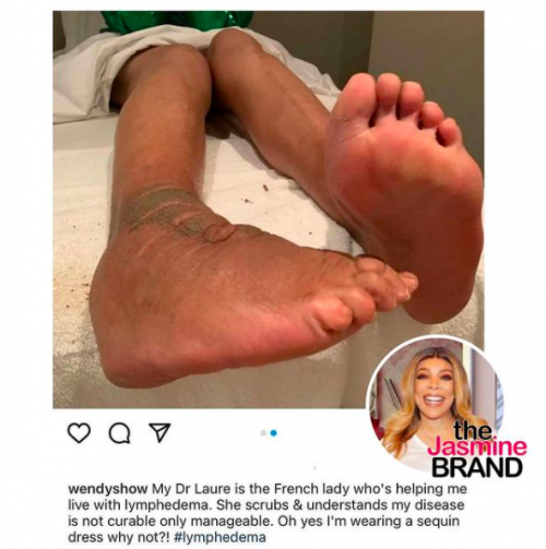 Wendy Williams Speaks Candidly About Lymphedema Foot Condition In