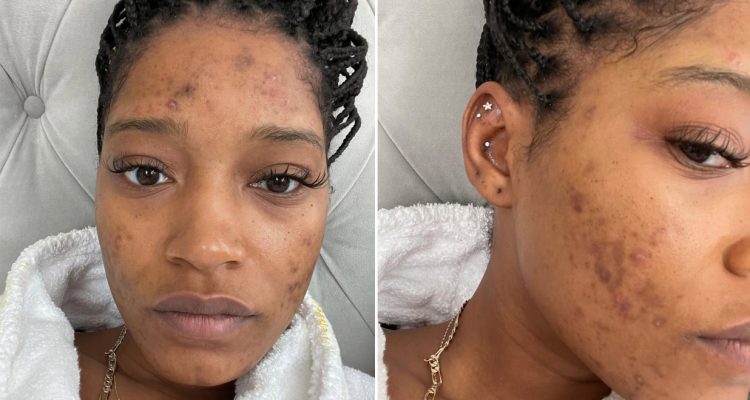 Keke Palmer Speaks Candidly About Polycystic Ovarian Syndrome and Acne